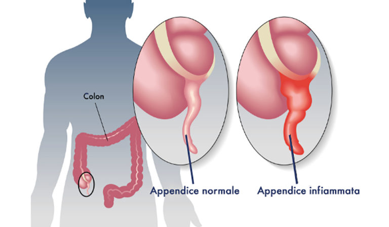 Appendicite Acuta Sintomi Cause E Rimedi Appendice Infiammata Dolori 3797