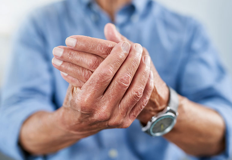 Artrosi alle mani sintomi, cause e trattamento